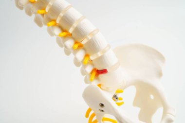 Omurga ve kemik, bel kemiği yerinden oynamış disk parçası, ortopedi bölümünde tedavi için model..