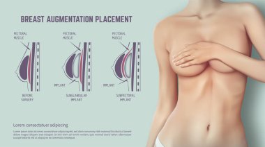 Diyagram ekleme yöntemi için meme hakkında implant. Resimde plastik cerrahi meme implantları.