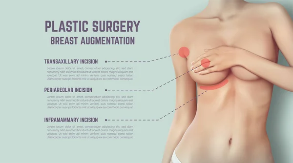 Plastic Surgery Breast Implants Illustration Shows Incision Methods — Stock Vector