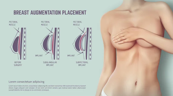 Diagram Method Insertion Breast Implant Plastic Surgery Breast Implants Illustration — Stock Vector