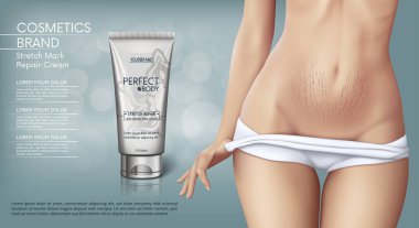 Web banner design of Stretch mark removal cream. Concept vector illustration of skin care and with woman with stretch marks on belly clipart