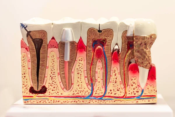 歯科インプラントと採石場の悪い歯のインストールのモデル展示場 — ストック写真