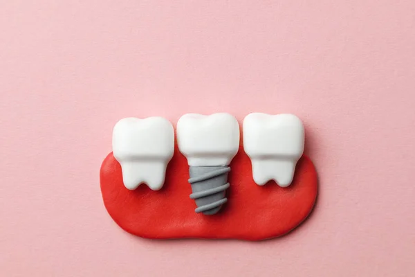 Egészséges fehér fogak és a rózsaszín háttér implantátumok. — Stock Fotó