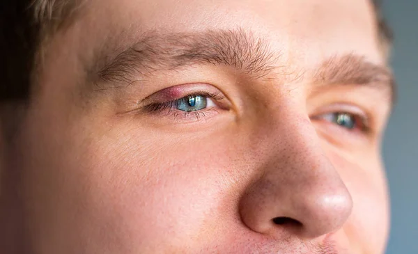 Concentration sélective sur le couvercle rouge gonflé et douloureux de l'œil supérieur avec apparition d'une infection de la teinture due à une glande huileuse obstruée et à des bactéries staphylococciques. Abcès de la paupière supérieure droite . — Photo