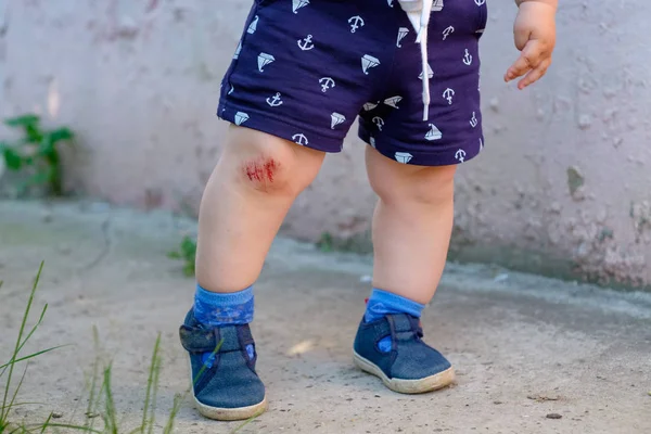 Abrasão Sangue Joelho Como Resultado Cair Sobre Asfalto Pequeno Menino — Fotografia de Stock