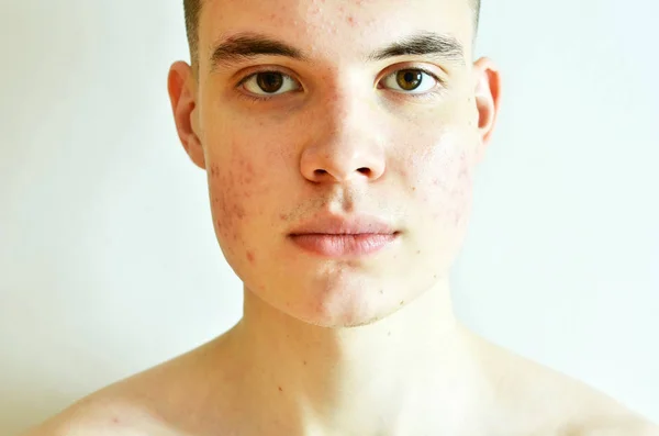 問題のある肌とにきびからの傷を持つ男のクローズ アップ — ストック写真