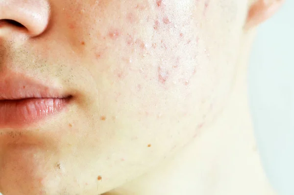 Close Van Man Met Problematische Huid Littekens Van Acne — Stockfoto