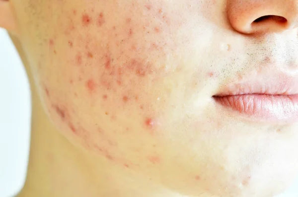 Primo Piano Dell Uomo Con Pelle Problematica Cicatrici Acne — Foto Stock