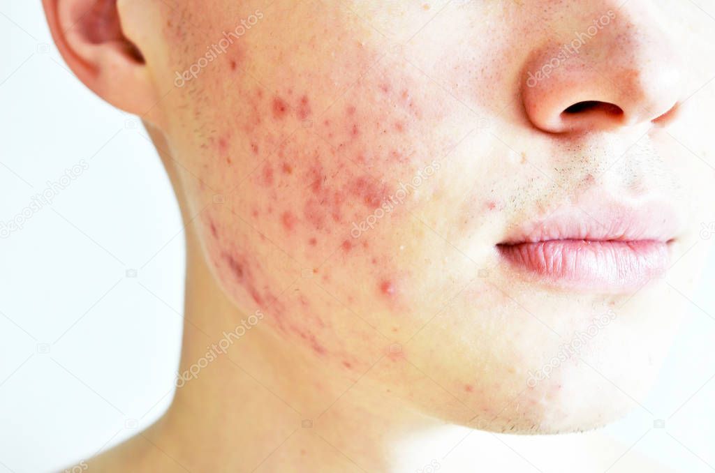 Close up of man with problematic skin and scars from acne