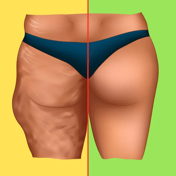 Cellulite Sur Les Fesses Femme Avant Après Sport Procédure Médicale — Image vectorielle