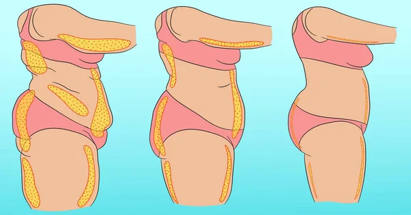 Corpo Femminile Con Designazione Cellulite Grasso — Vettoriale Stock