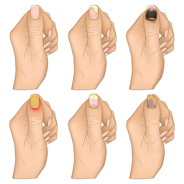 Maladies Des Ongles Illustrées Sur Une Main — Image vectorielle