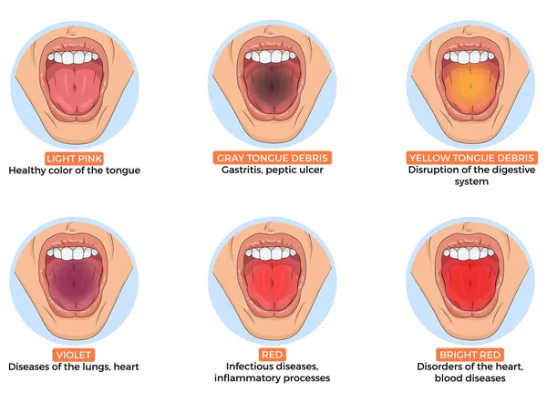 Illustrazione Della Diagnosi Diverse Malattie Dal Colore Della Lingua — Vettoriale Stock