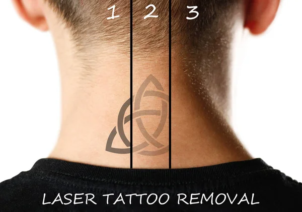 Remoção Tatuagem Laser Fecha Isolado Sobre Fundo Branco — Fotografia de Stock