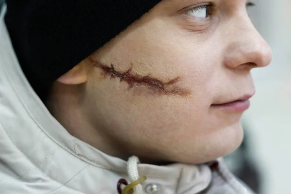 スカーフェイス 彼の顔に大きな傷を持つ若い男 — ストック写真