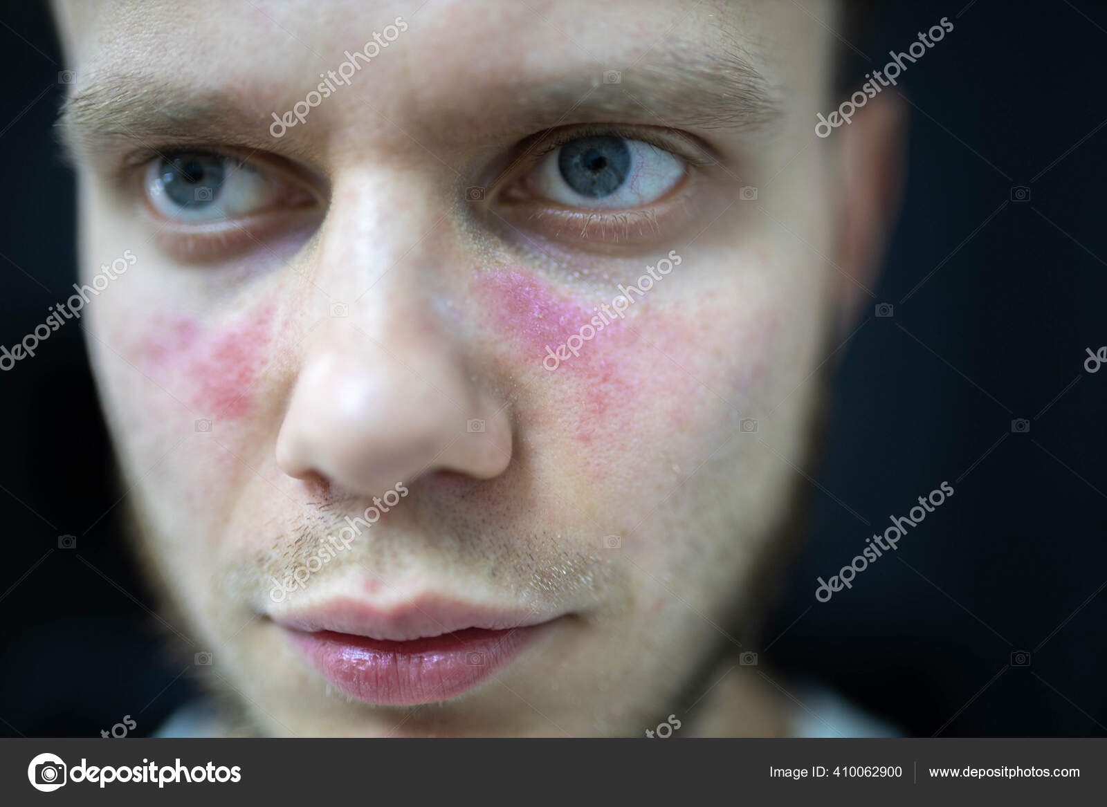 Age Spots Redness Face Young Man Sick Systemic Lupus Erythematosus Stock Photo By C Velimirisaevich Age Spots Redness Face Young Man Sick Systemic Lupus Erythematosus Stock Photo By C Velimirisaevich
