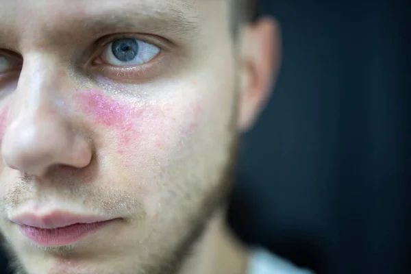 Yüzünde kızarıklık yaşları var. Genç bir adam hastalıklı, sistemik lupus eritematoz hastası.