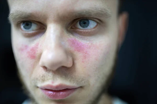 Yüzünde kızarıklık yaşları var. Genç bir adam hastalıklı, sistemik lupus eritematoz hastası.