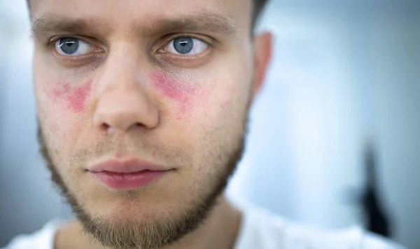 Leeftijd Vlekken Van Roodheid Het Gezicht Een Jonge Man Ziek — Stockfoto