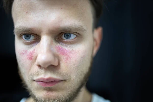 age spots of redness on the face, a young man is sick systemic lupus erythematosus