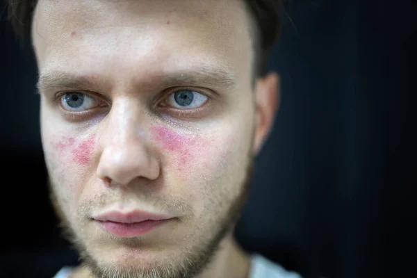 Yüzünde kızarıklık yaşları var. Genç bir adam hastalıklı, sistemik lupus eritematoz hastası.