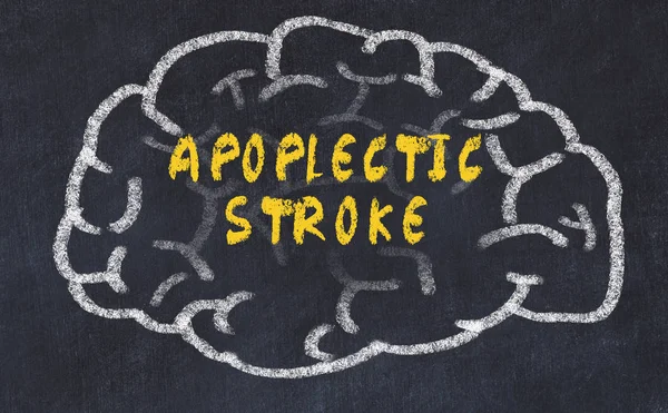 Desenho de giz do cérebro humano com inscrição apoplética acidente vascular cerebral — Fotografia de Stock