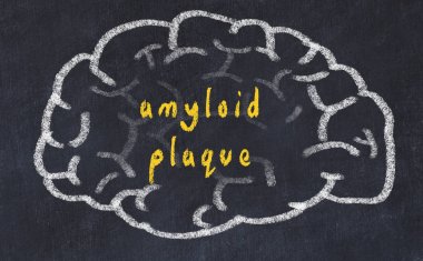 Yazıt amiloid plak ile tebeşir üzerinde insan beyninin Drawind