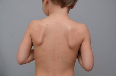Sırt ve boyun dolu kabarcıklar, yara izi ve döküntü tarafından chickenpox neden closeup