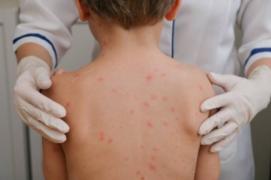 Doktor babys cilt inceliyor dolu kabarcıklar, yara izi ve döküntü neden tarafından chickenpox