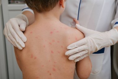 Doktor babys cilt inceliyor dolu kabarcıklar, yara izi ve döküntü neden tarafından chickenpox