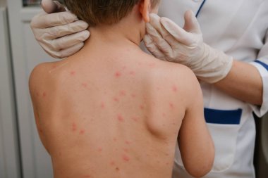 Doktor babys cilt inceliyor dolu kabarcıklar, yara izi ve döküntü neden tarafından chickenpox