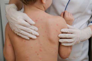 Doktor babys cilt inceliyor dolu kabarcıklar, yara izi ve döküntü neden tarafından chickenpox