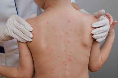 Doktor babys cilt inceliyor dolu kabarcıklar, yara izi ve döküntü neden tarafından chickenpox