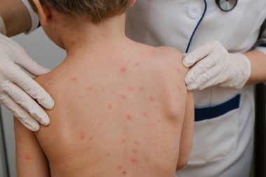 Doktor babys cilt inceliyor dolu kabarcıklar, yara izi ve döküntü neden tarafından chickenpox
