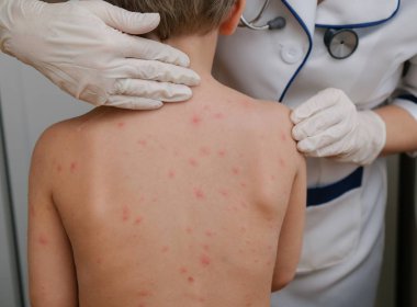 Doktor babys cilt inceliyor dolu kabarcıklar, yara izi ve döküntü neden tarafından chickenpox
