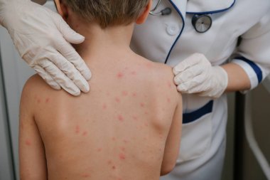 Doktor babys cilt inceliyor dolu kabarcıklar, yara izi ve döküntü neden tarafından chickenpox