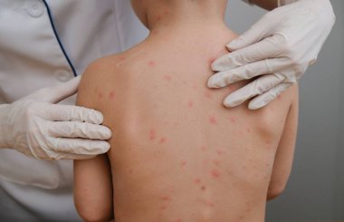 Doktor babys cilt inceliyor dolu kabarcıklar, yara izi ve döküntü neden tarafından chickenpox