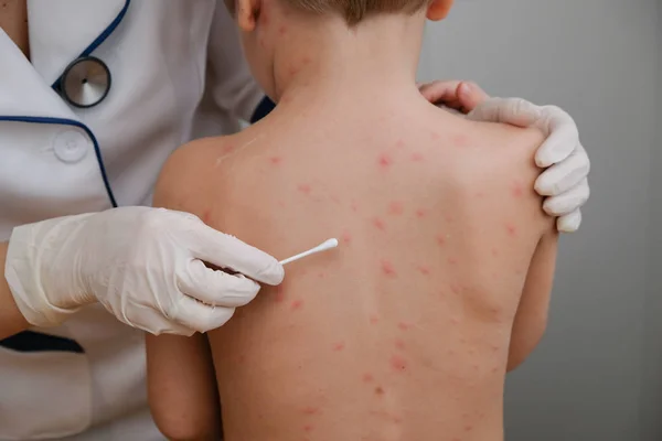 Doktor babys cilt kabarcıklar ve tarafından chickenpox neden döküntü ile krem uygulamak