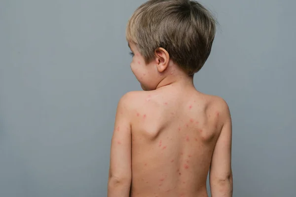 Sırt ve boyun dolu kabarcıklar, yara izi ve döküntü tarafından chickenpox neden closeup