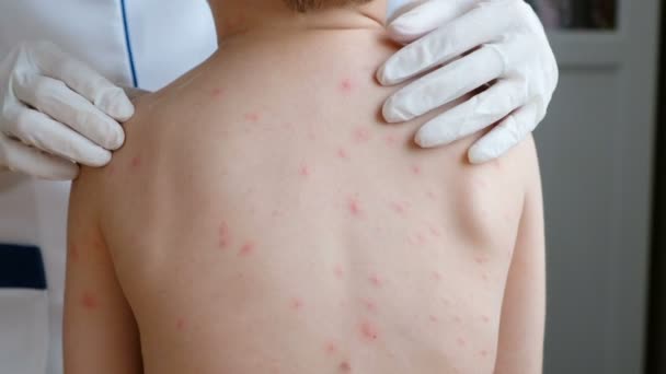 Doctor examines babys skin full of blisters,scar and rash caused by chickenpox — Αρχείο Βίντεο