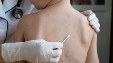 Doktor babys cilt kabarcıklar ve tarafından chickenpox neden döküntü ile krem uygulamak