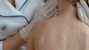 Yakın çekim çocuk çıplak vücut sivilce Tavuk Pox'u ile. su çiçeği çocuğun vücudunda sivilce