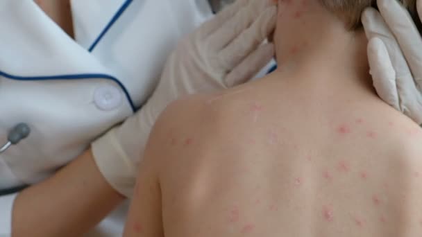Close Corpo Criança Com Espinhas Varíola Frango Espinhas Corpo Criança — Vídeo de Stock
