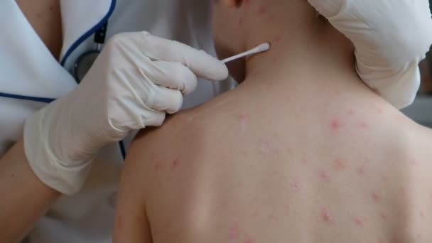 Medico che applica la crema alla pelle dei bambini con vesciche e rash causato dalla varicella — Video Stock