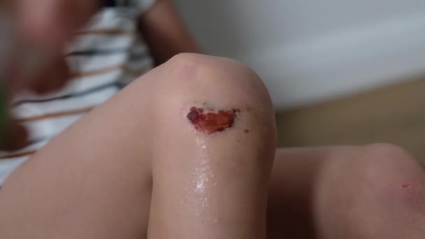 Κοντινά πλάνα από τραυματισμένα νεαρά παιδιά γόνατος. Κάποιος ψέκασε αντισηπτικά στην τριβή. — Αρχείο Βίντεο