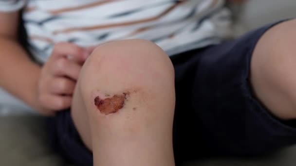 Close-up van geblesseerde jonge kinderen knie. Iemand spray antiseptoc te schuren — Stockvideo