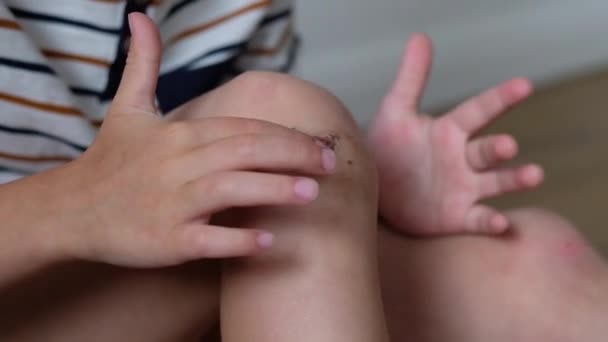 Close-up van geblesseerde jonge kinderen knie. Jongen zet genezing zalf te schuren — Stockvideo