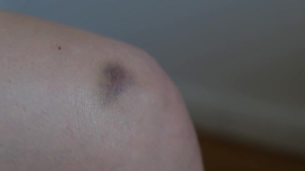 Женщина наносит крем на синяк на колене, крупным планом — стоковое видео