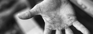 Palmiye Nasır ile. Zor iş kavramı. El ile işten yaralı yandan kabarcıklar.