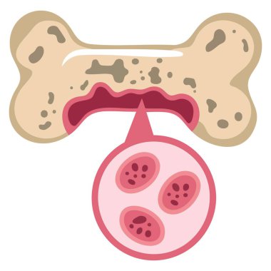 Sarkoma kemiği kanseri farkındalığı ikonu izole edilmiş vektör illüstrasyon kurdelesi kanser görselleri için tıbbi sağlık destek farkındalığı kavramı